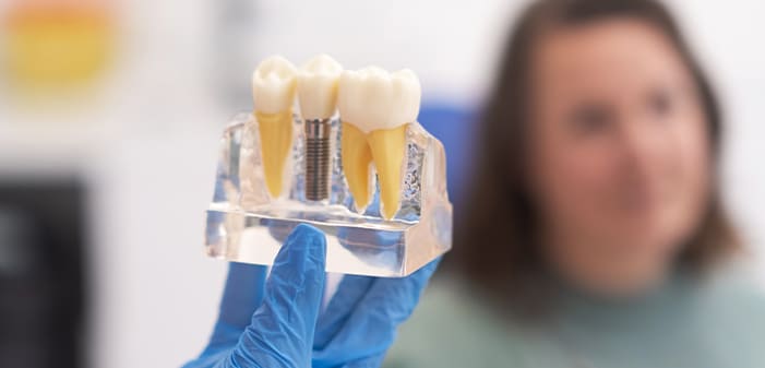 Samsun'da İmplant Tedavisi - Samsun Bilim Diş Kliniği