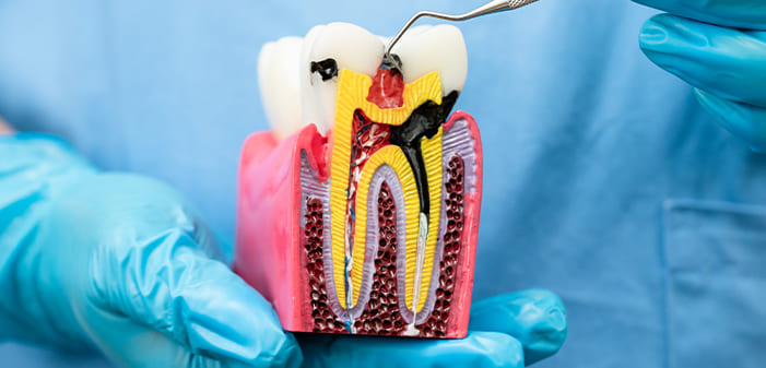 Samsun Kanal Tedavisi - Samsun Bilim Diş Kliniği